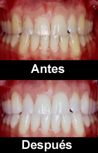 Blanqueamiento dental